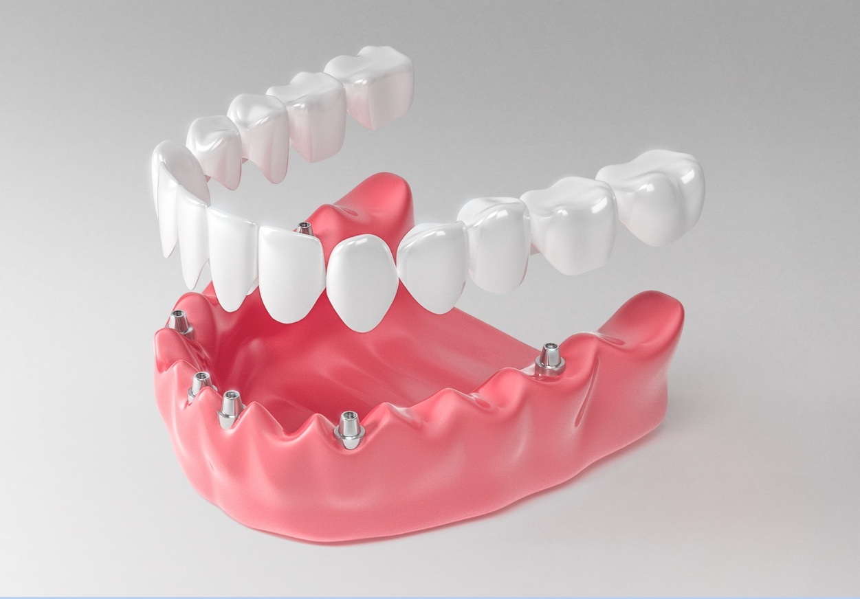 Протезирование челюсти при полном отсутствии зубов