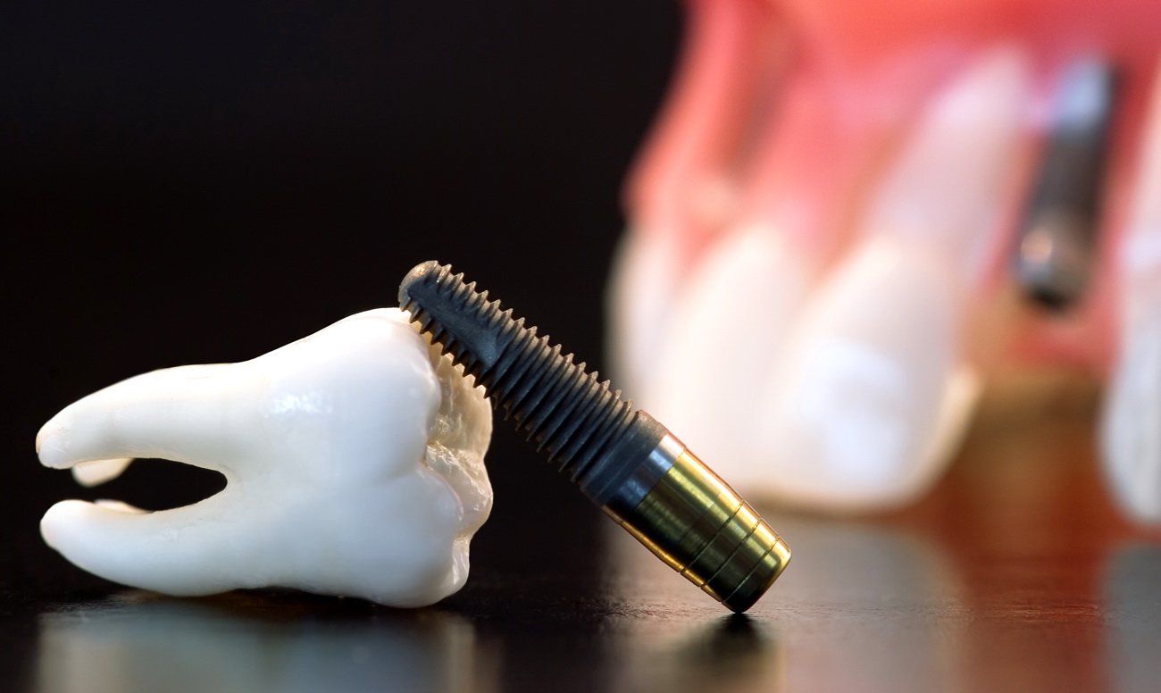 Как проходит подготовка к имплантации зубов?
