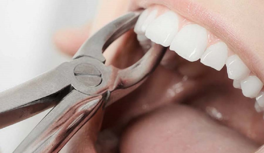Удаление корней зубов в стоматологии