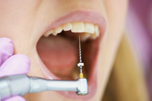 Удаление нерва в стоматологии